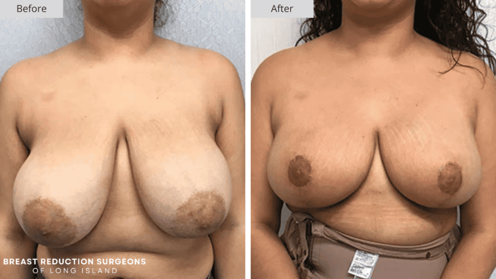 Breast Reduction Long Island Before and After Patient 10 Front
