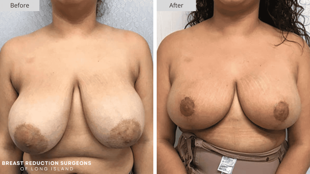 Breast Reduction Long Island Before and After Patient 10