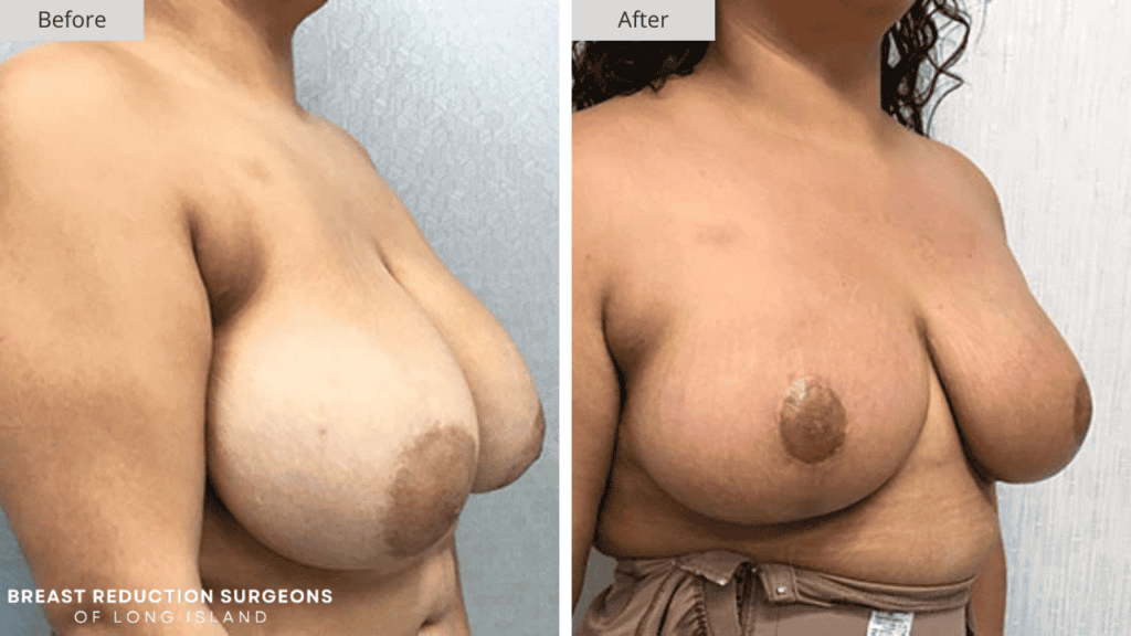Breast Reduction Long Island Before and After Patient 10