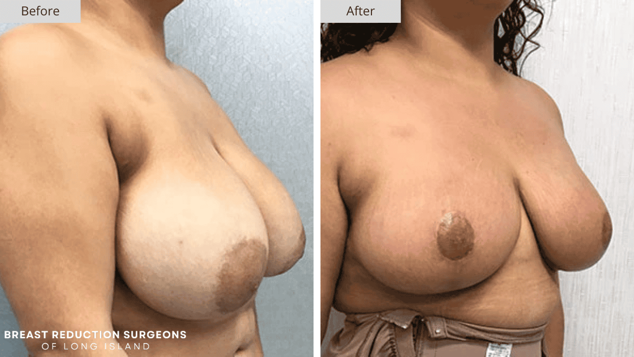 Breast Reduction Long Island Before and After Front Patient 10