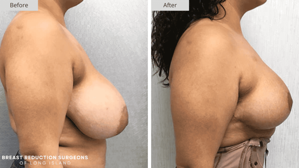 Breast Reduction Long Island Before and After Patient 10 Side