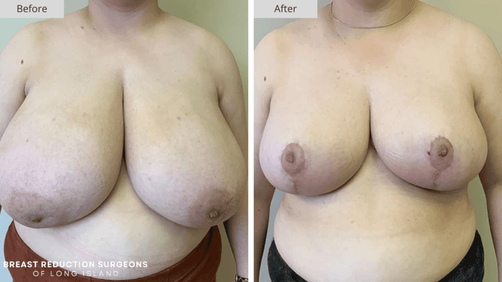 Breast Reduction Long Island Before and After Patient 11 Front