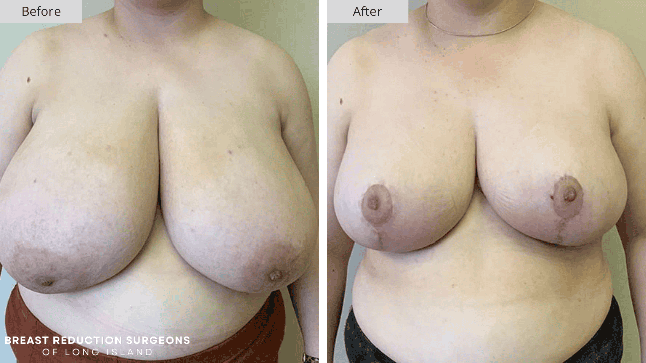 Breast Reduction Long Island Before and After Patient 11