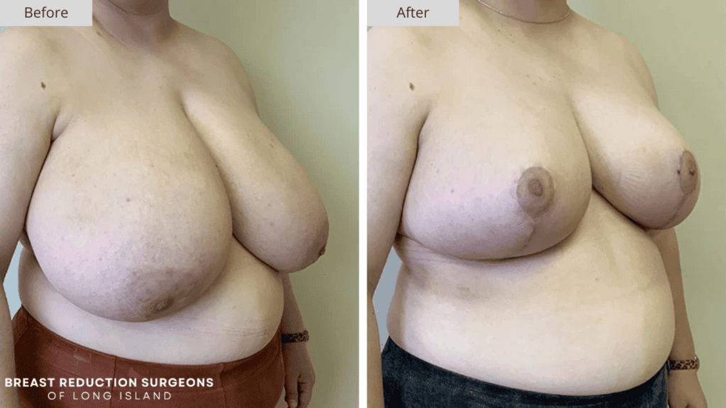 Breast Reduction Long Island Before and After Patient 11