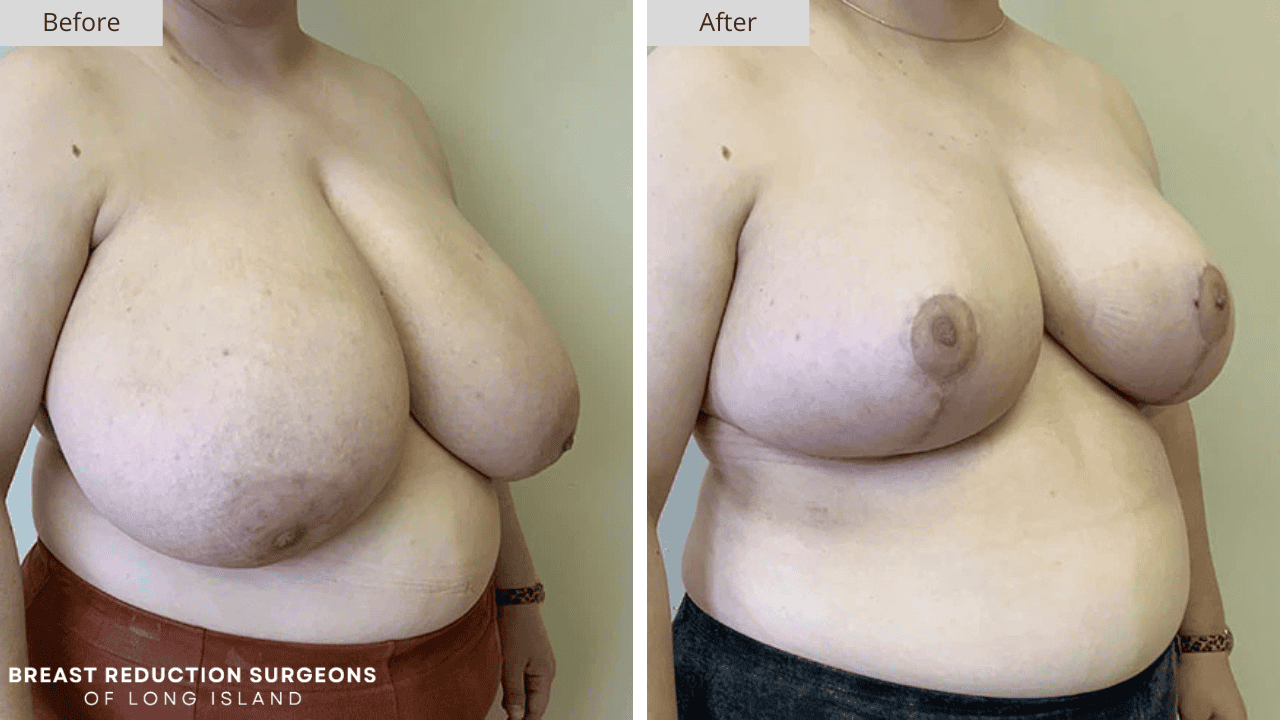 Breast Reduction Long Island Before and After Front Patient 11
