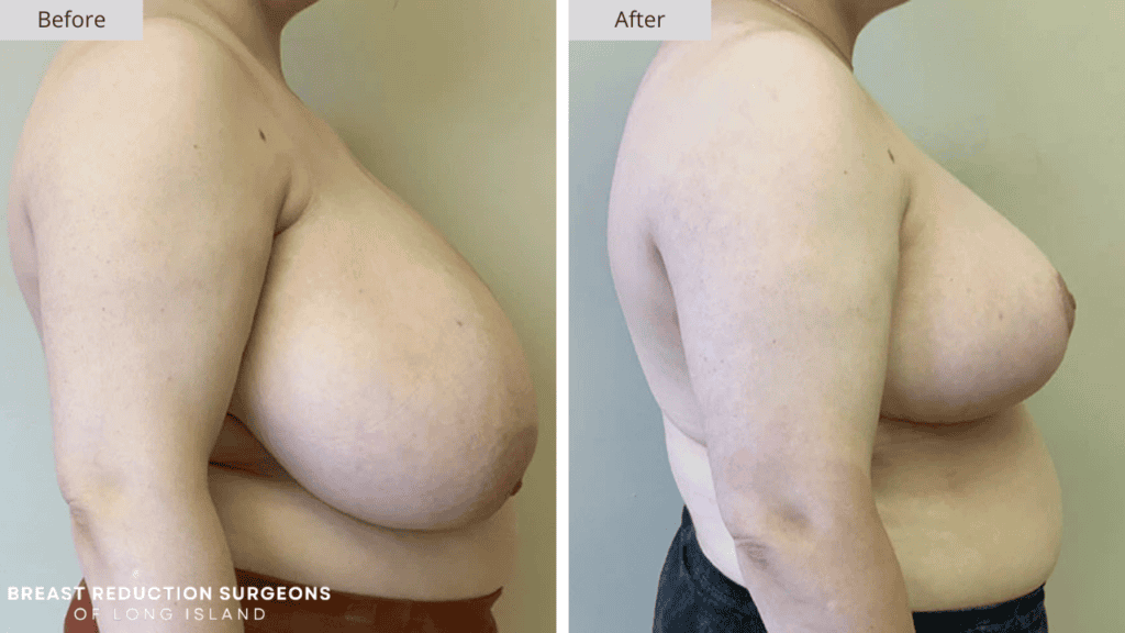 Breast Reduction Long Island Before and After Patient 11 Side