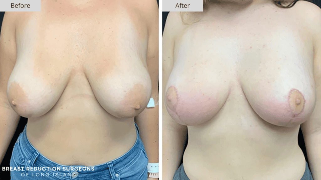 Breast Reduction Long Island Before and After Patient 12 Front