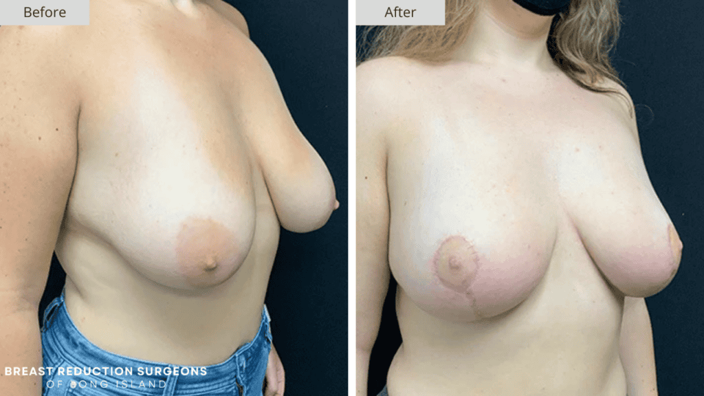Breast Reduction Long Island Before and After Patient 12
