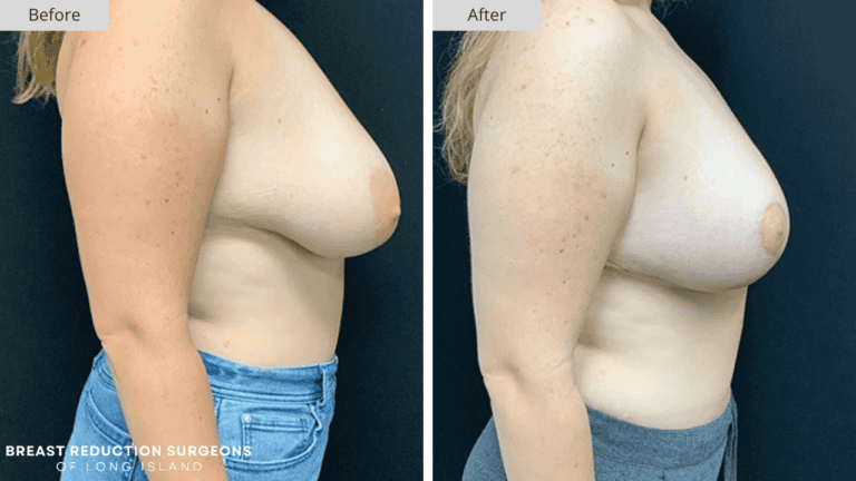 Breast Reduction Long Island Before and After Side Patient 12