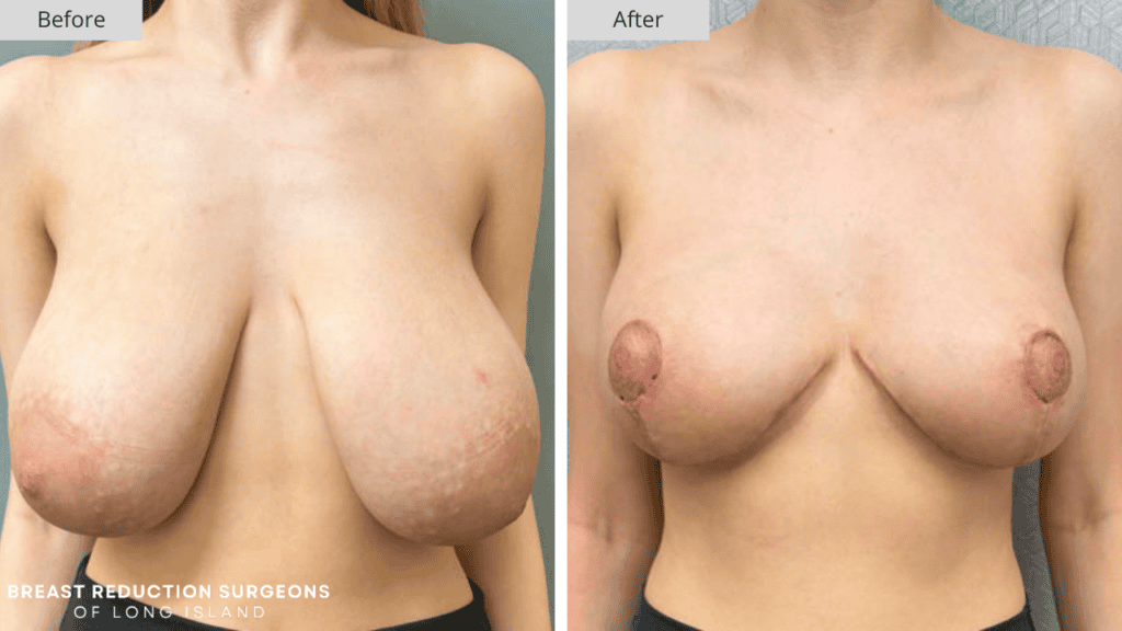Breast Reduction Long Island Before and After Patient 1 Front