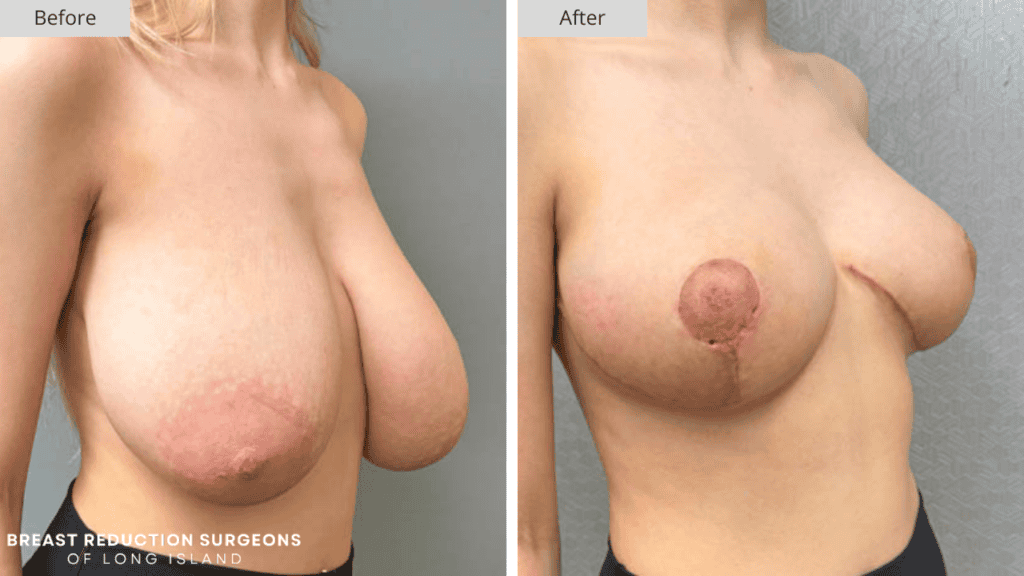 Breast Reduction Long Island Before and After Patient 1