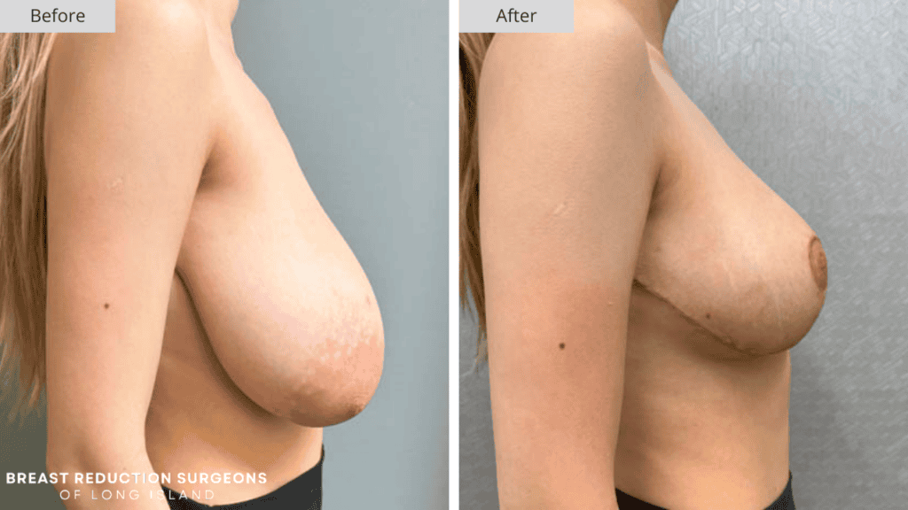 Breast Reduction Long Island Before and After Patient 1 Side