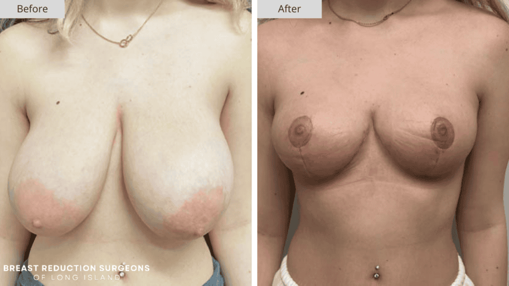 Breast Reduction Long Island Before and After Patient 2 Front