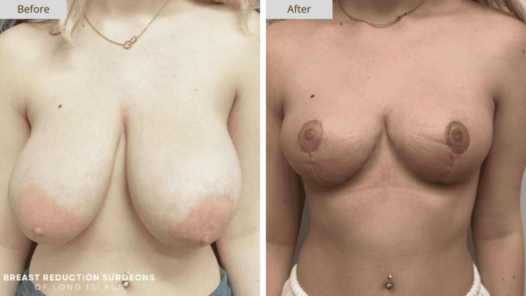 Breast Reduction Long Island Before and After Front Patient 2