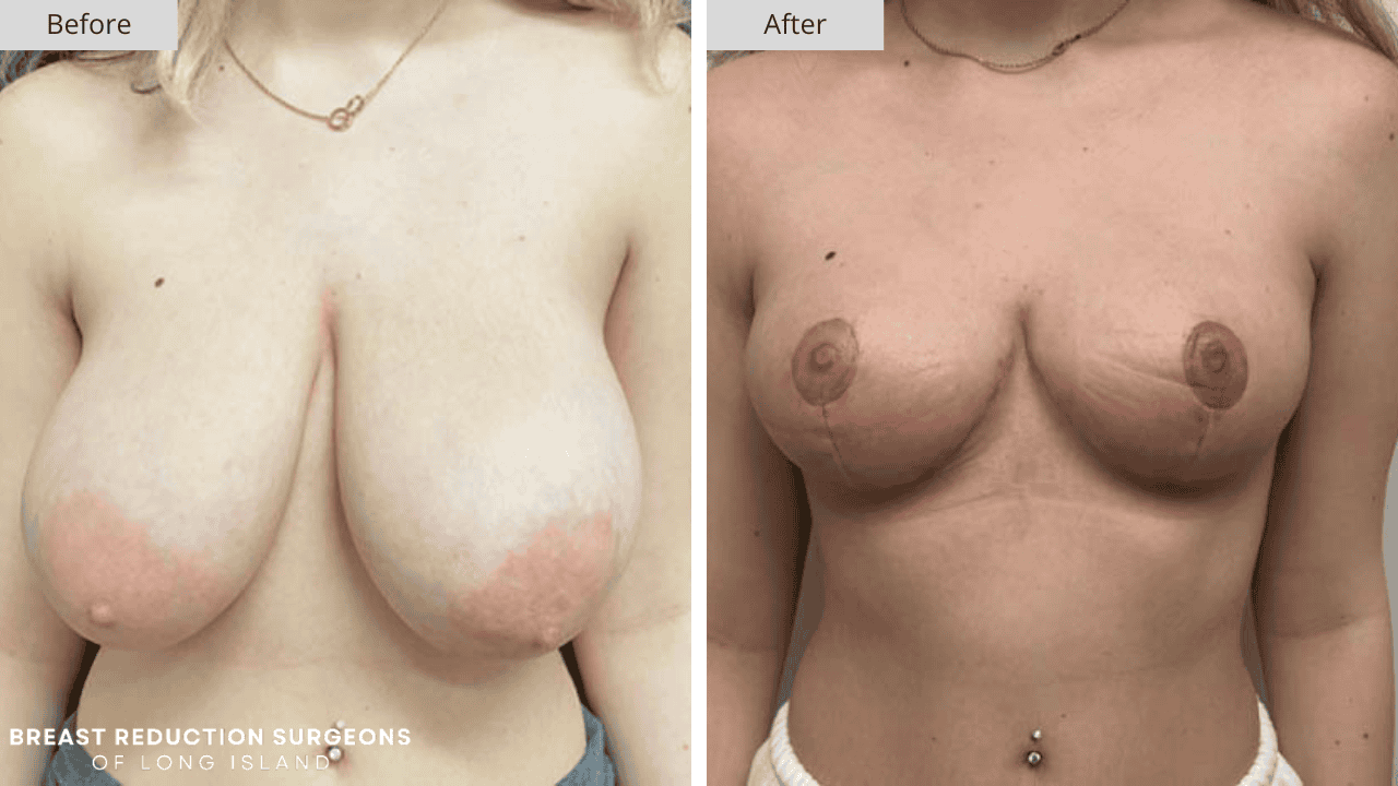 Breast Reduction Long Island Before and After Front Patient 2