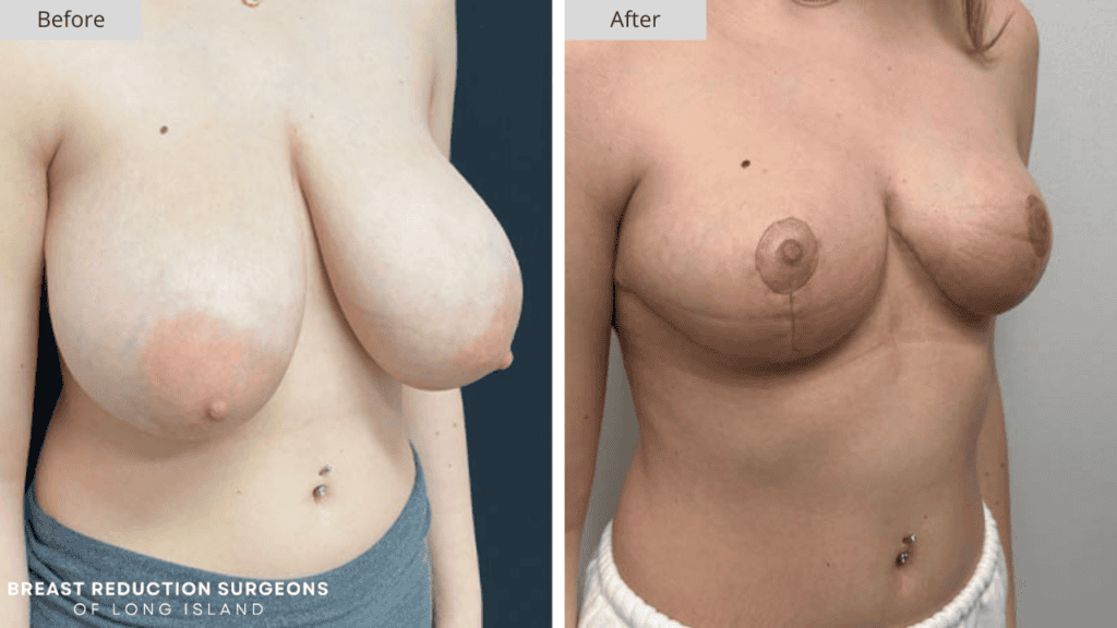 Breast Reduction Long Island Before and After Patient 2