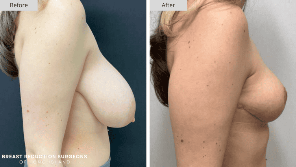 Breast Reduction Long Island Before and After Patient 2 Side
