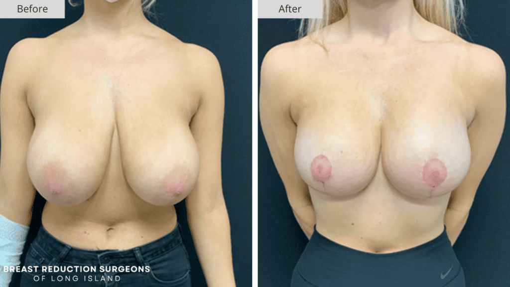 Breast Reduction Long Island Before and After Patient 3 Front