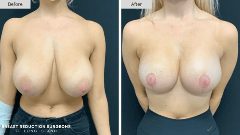 Breast Reduction Long Island Before and After Front Patient 3