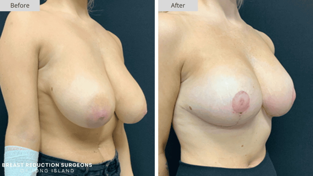Breast Reduction Long Island Before and After Patient 3