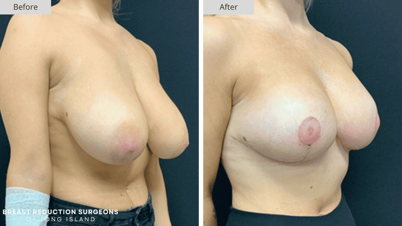 Breast Reduction Long Island Before and After Patient 3