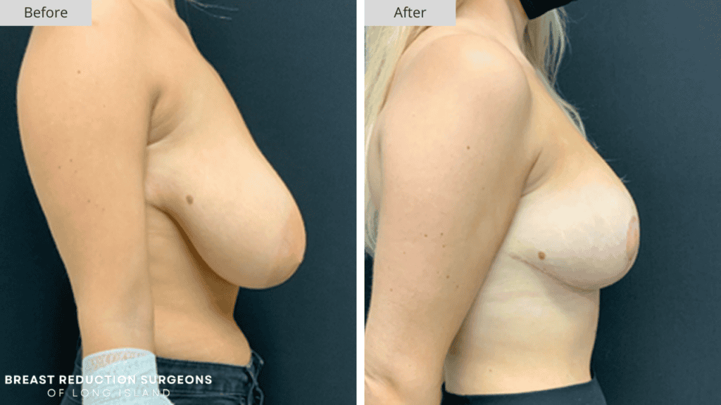 Breast Reduction Long Island Before and After Patient 3 Side