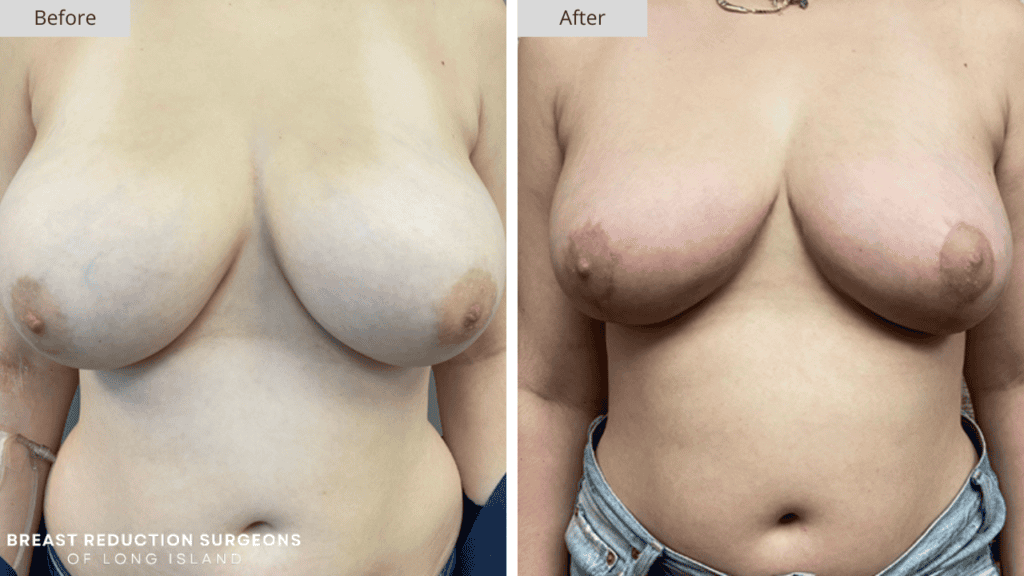 Breast Reduction Long Island Before and After Patient 4 Front