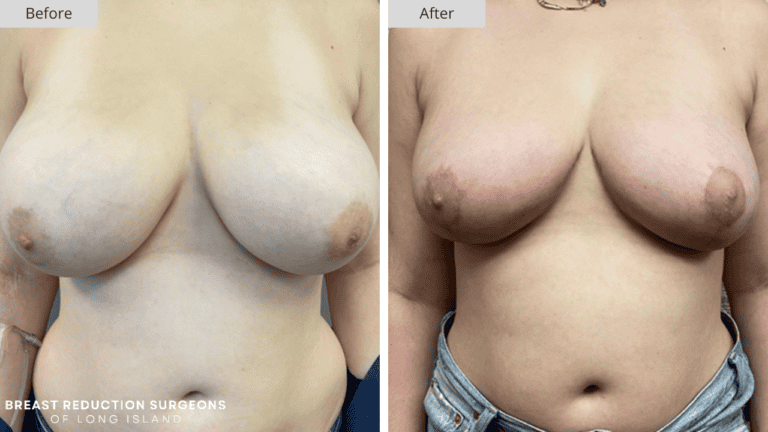 Breast Reduction Long Island Before and After Front Patient 4