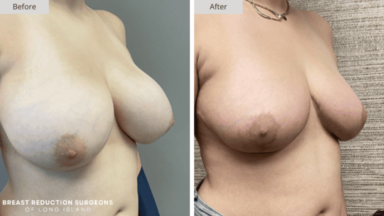 Breast Reduction Long Island Before and After Patient 4