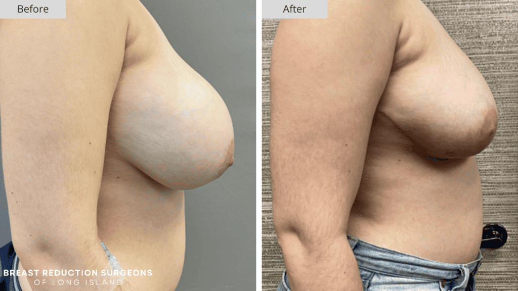 Breast Reduction Long Island Before and After Patient 4 Side
