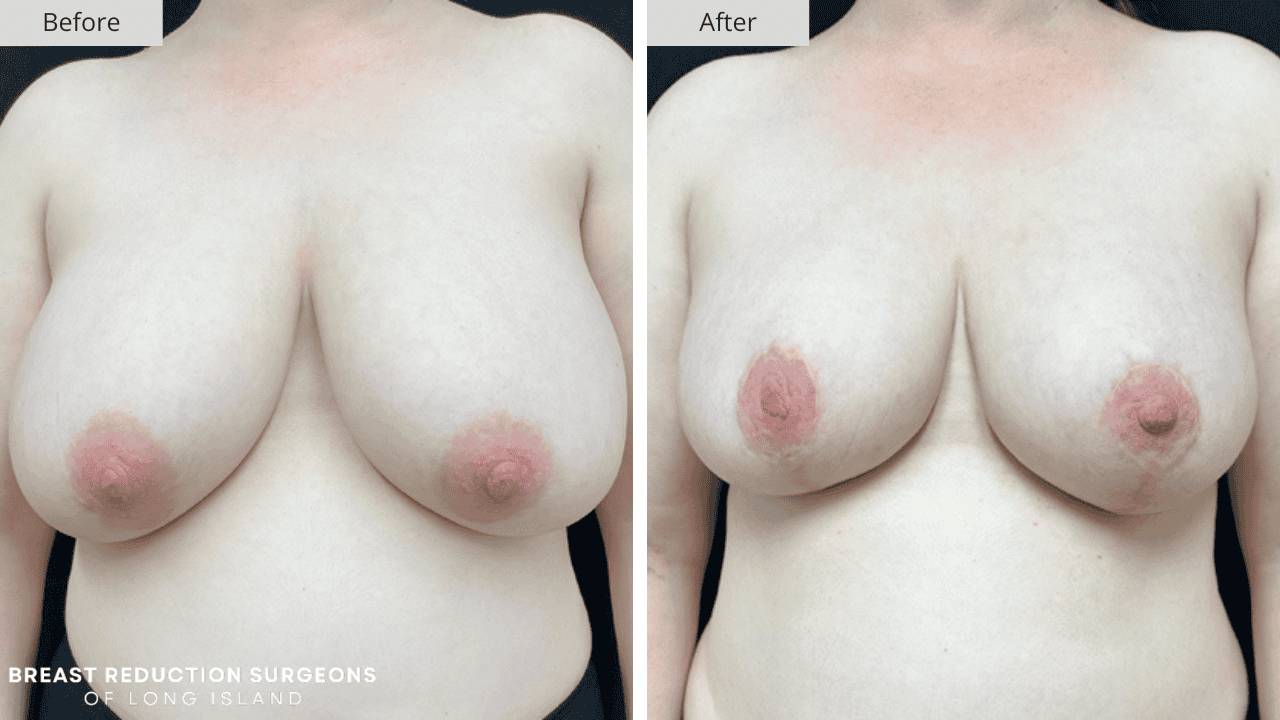 Breast Reduction Long Island Before and After Front Patient 5