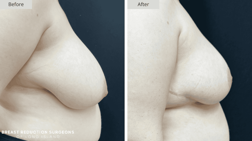 Breast Reduction Long Island Before and After Side Patient 5