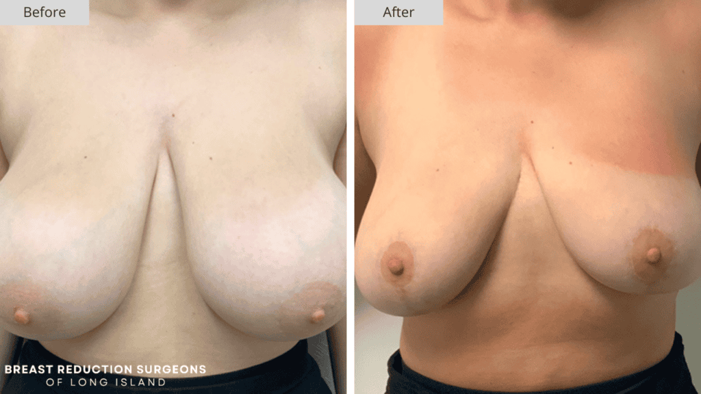 Breast Reduction Long Island Before and After Patient 5 Front