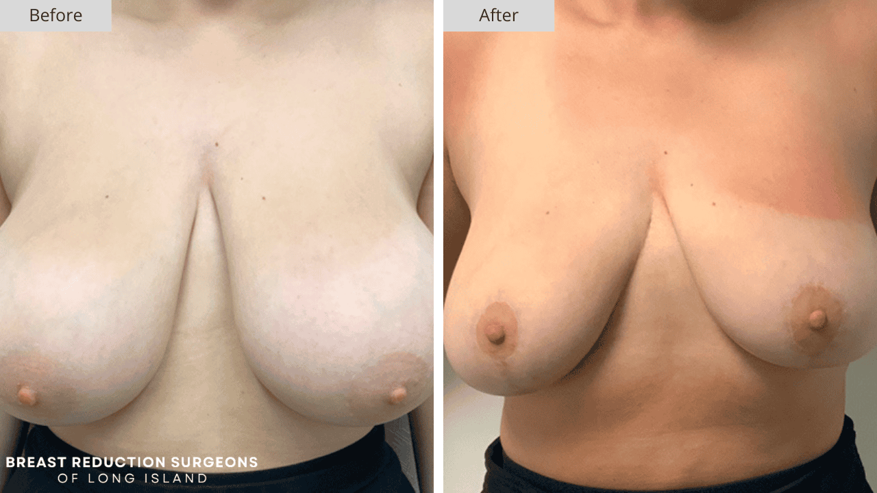 Breast Reduction Long Island Before and After Front Patient 6