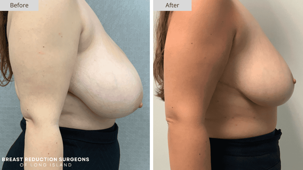 Breast Reduction Long Island Before and After Side Patient 6