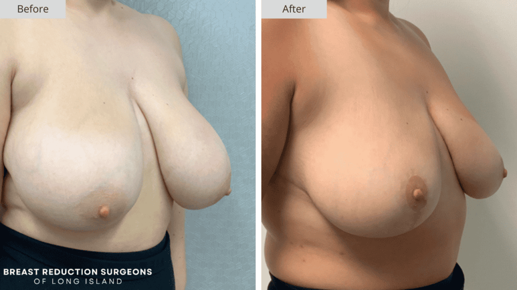 Breast Reduction Long Island Before and After Patient 5 Side