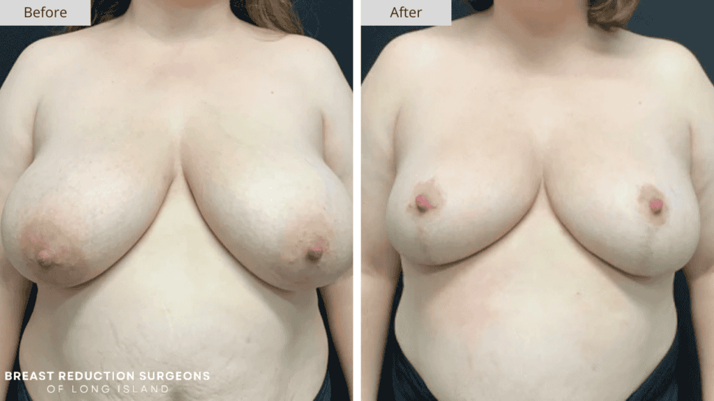 Breast Reduction Long Island Before and After Patient 7 Front