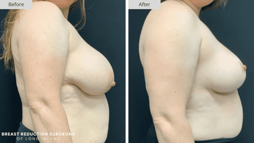 Breast Reduction Long Island Before and After Patient 7 Side