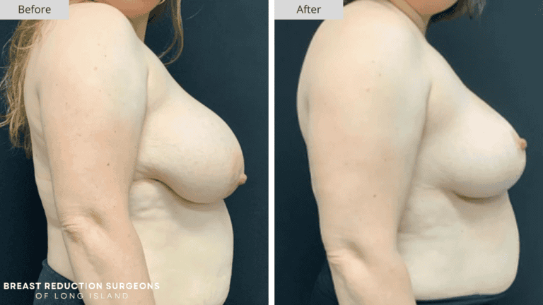 Breast Reduction Long Island Before and After Side Patient 7