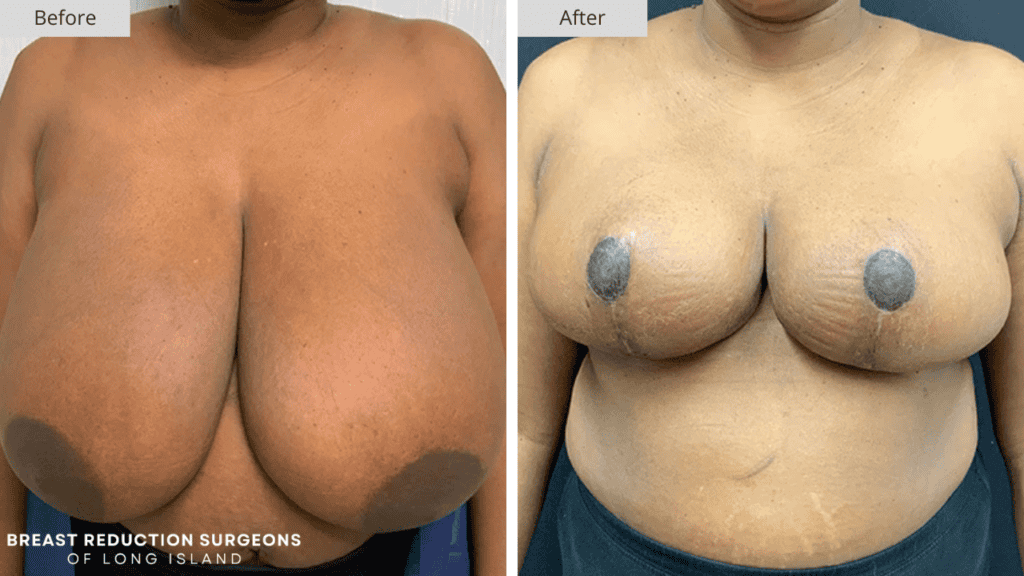 Breast Reduction Long Island Before and After Patient 8 Front
