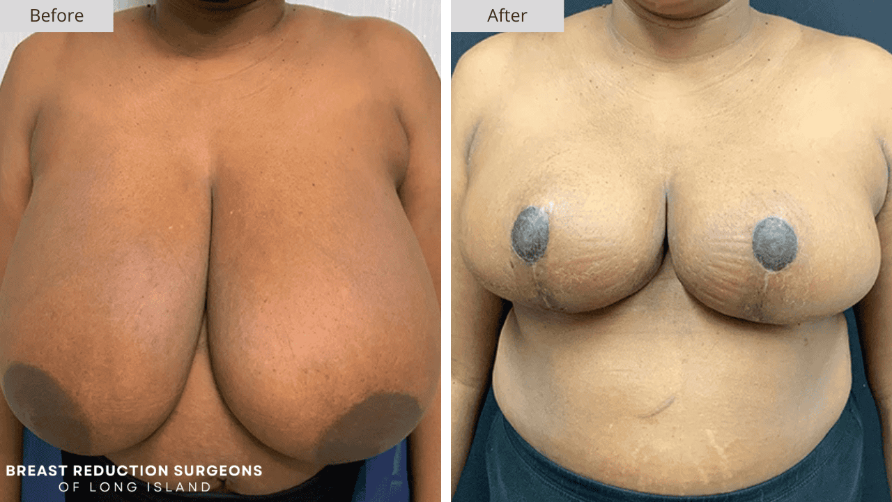 Breast Reduction Long Island Before and After Front Patient 8