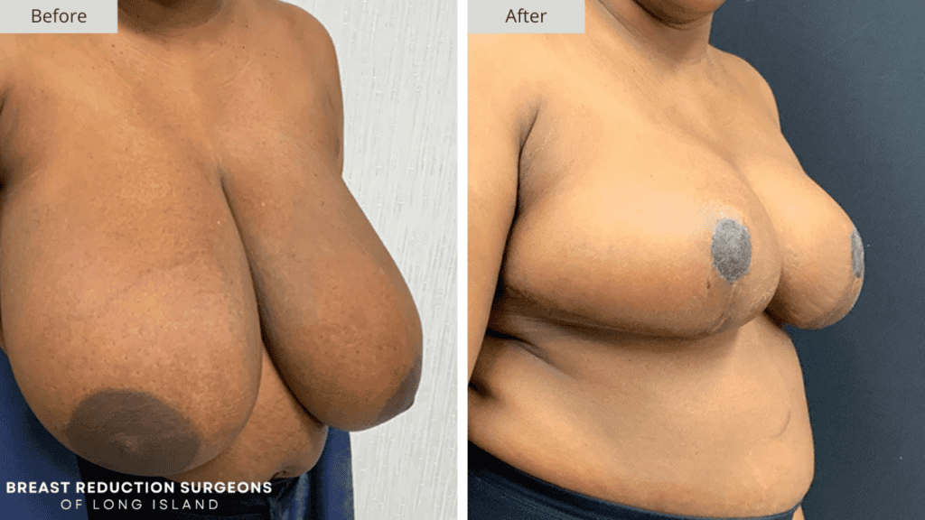 Breast Reduction Long Island Before and After Patient 8