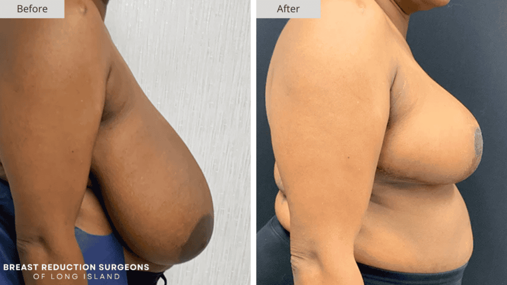 Breast Reduction Long Island Before and After Patient 8 Side