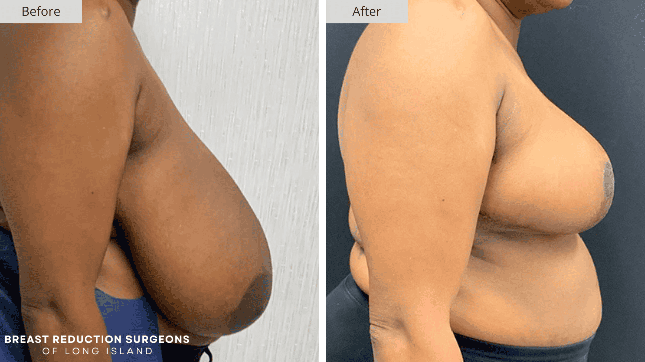 Breast Reduction Long Island Before and After Side Patient 8