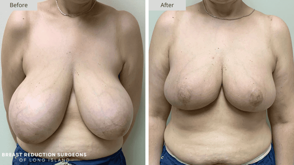 Breast Reduction Long Island Before and After Patient 9 Front