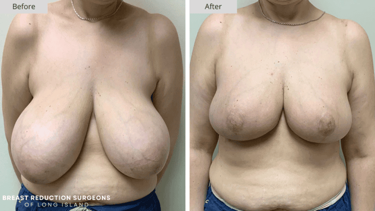 Breast Reduction Long Island Before and After Front Patient 9