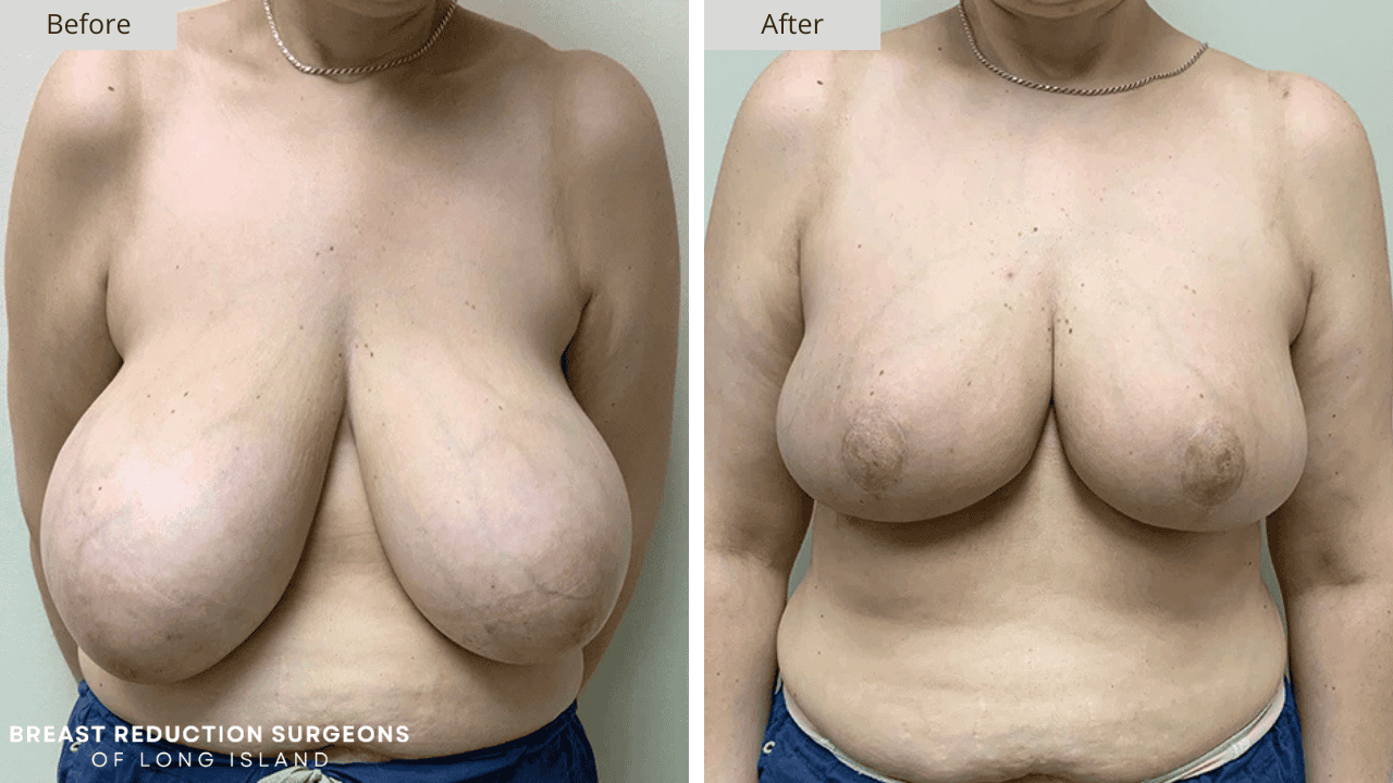 Breast Reduction Long Island Before and After Front Patient 9