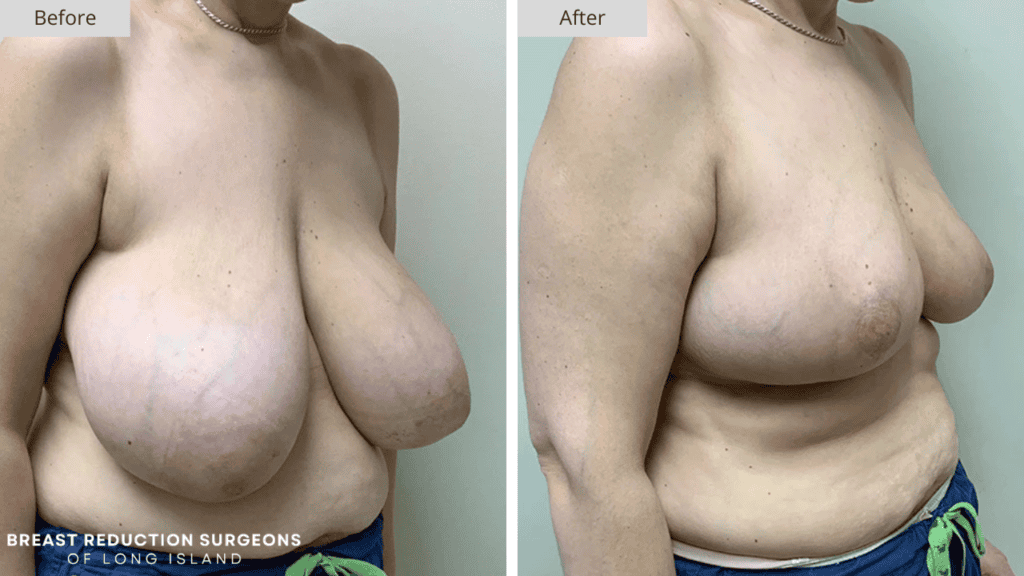 Breast Reduction Long Island Before and After Patient 9