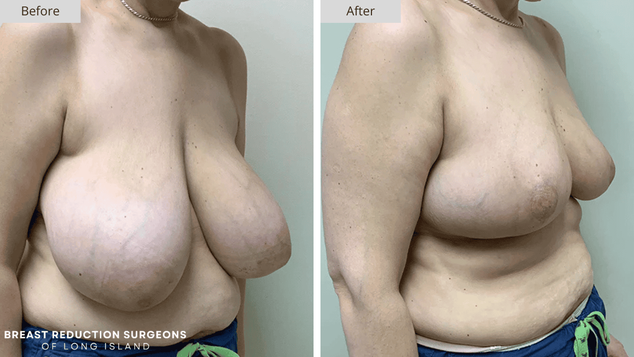 Breast Reduction Long Island Before and After Patient 9