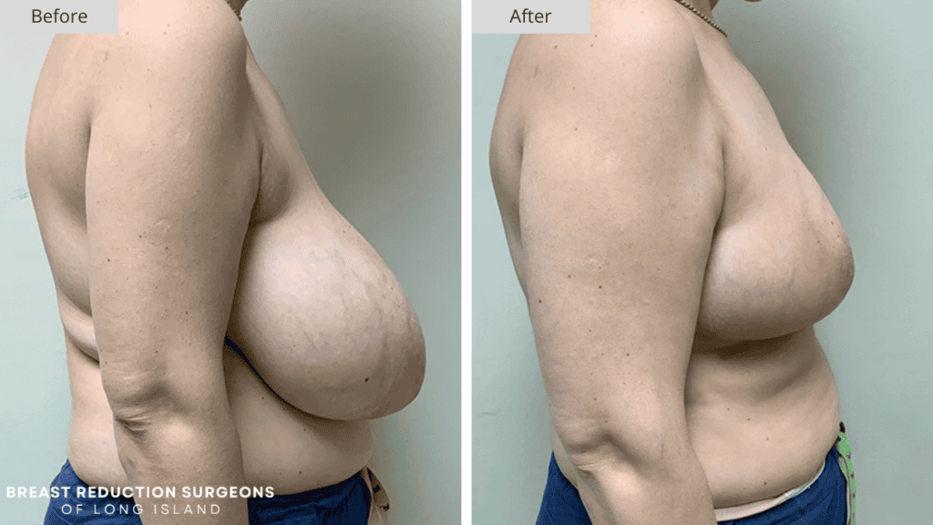Breast Reduction Long Island Before and After Patient 9 Side